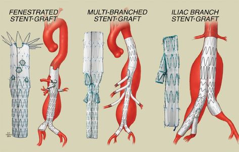 Cath Lab Nursing, Cardiac Cath, Superior Mesenteric Artery, Clinical Instructor, Medical Diagrams, Vascular Ultrasound, Interventional Cardiology, Medicine Art, Coding Tips