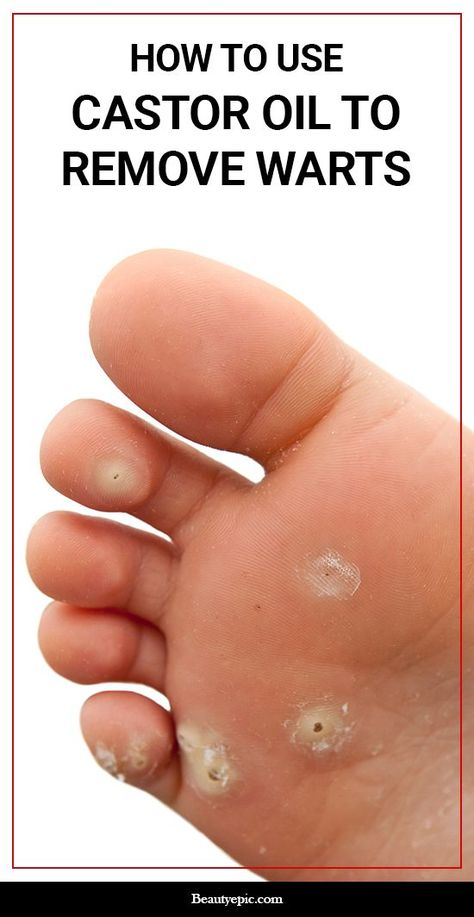 Planters Wart, What Causes Warts, Using Castor Oil, Warts On Hands, Warts On Face, Home Remedies For Warts, Warts Remedy, How To Remove Warts, Remove Warts