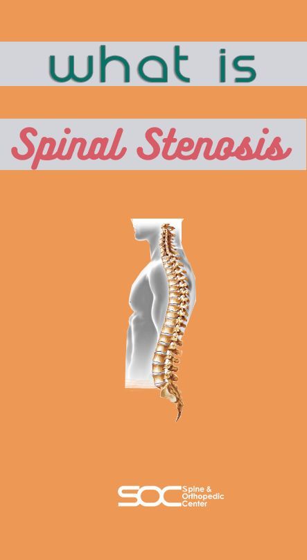 Stenosis Of The Spine, Stenosis Exercises, Spinal Degeneration, Spinal Fusion Surgery, Spinal Fusion, Spinal Decompression, Spinal Surgery, Spinal Nerve, Spinal Injury