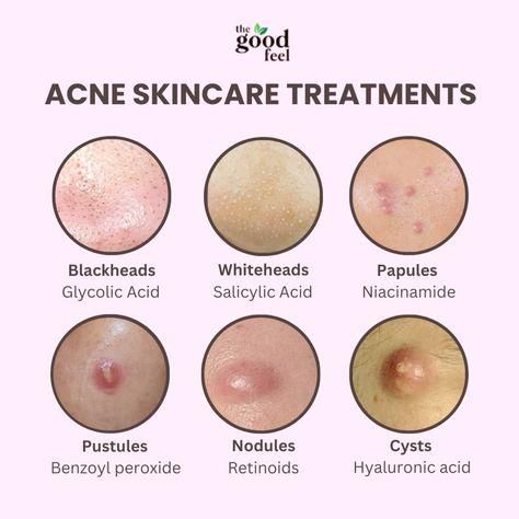 Unlock the secret to clearer skin with targeted treatments for every type of acne🌿 Seasonal Skincare, Types Of Acne, Face Acne, Clearer Skin, Hormone Balancing, Blackhead Remover, Skin Care Essentials, Good Skin, Clear Skin