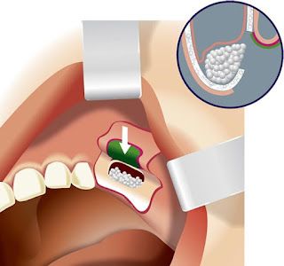 Maxillary Sinus, Sinus Cavities, Bone Grafting, Molar Tooth, Tooth Replacement, Teeth Implants, Nerve Damage, Jaw Bone, Growth Factor