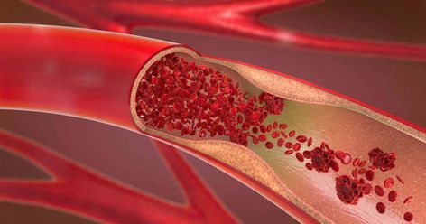 What Does a Blood Clot Feel Like? Experts Share Common Signs and Symptoms Coronary Arteries, Shortness Of Breath, Chest Pain, Cardiovascular Disease, Lower Blood Pressure, Signs And Symptoms, Blood Vessels, Blood Circulation, Omega 3