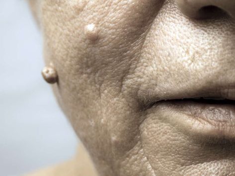 Warts are harmless growths that develop in response to a viral infection. Sometimes, warts may appear on the face. Read on to find out how to treat facial warts and when to see a doctor. Filiform Wart, Face Warts, Natural Wart Remedies, Flat Warts, Types Of Warts, Facial Warts, Warts On Face, Remove Skin Tags Naturally, Warts Remedy