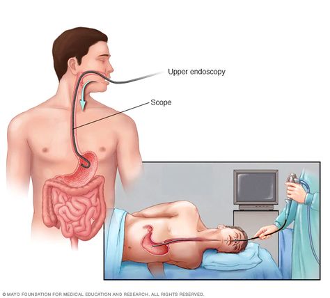 Esophageal Spasm, Ulcer Symptoms, Esophageal Varices, Tiny Camera, Small Intestine, Reflux Disease, Stomach Ulcers, Alternative Treatments, Mayo Clinic