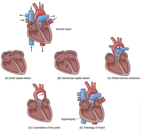 types of congenital heart defects Clinical Anatomy, Unwanted Hair Growth, Congenital Heart Defect, Heart Anatomy, Heart Defect, Congenital Heart, Medical School Essentials, Coronary Arteries, Diy Hair Care