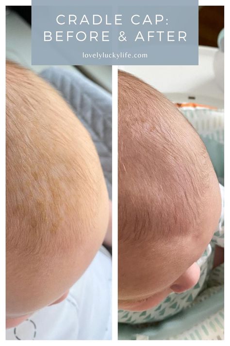 Toddler Cradle Cap, Cradle Cap Remedies, Baby Cradle Cap, Baby Acne, Hydrocortisone Cream, Scalp Brushing, Cradle Cap, Baby Care Tips, Flaky Skin