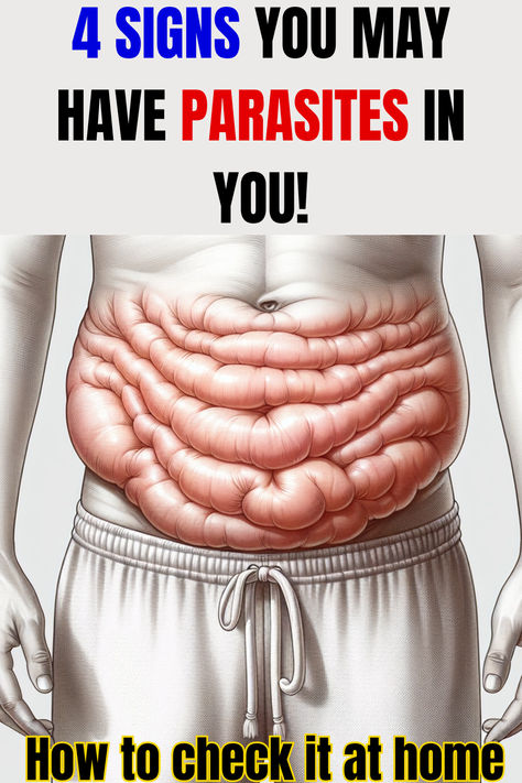 According to research by Cleveland Clinic and Manhattan Gastroenterology, signs of gut parasites may include digestive issues like diarrhea, abdominal discomfort, gas, bloating, nausea or vomiting, chronic fatigue, and skin problems such as rashes and itching.  Most people do not know it. #parasites #cleancefromparasite #parasitecleanse #gut #guthealth #bloating #gutparasites Parasite Cleanse, Healthy Remedies, Abdominal Discomfort, Stomach Cramps, Health Topics, Digestive Issues, Cleveland Clinic, Homeopathic Remedies, 80s Music