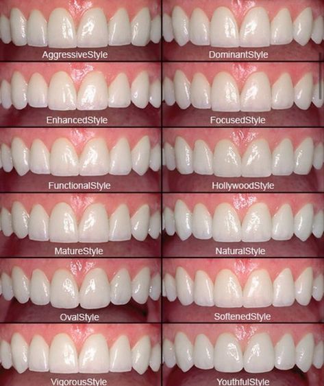 Pretty Teeth, Teeth Design, Veneers Teeth, Mom Activities, Teeth Whitening Diy, Beautiful Teeth, Dental Facts, Teeth Bleaching, Porcelain Veneers