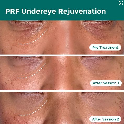 Restores lost volume & creates a more balanced facial symmetry with PRF 💉Stimulates new collagen ✨ Enhances regrowth of new healthy skin 🧚🏻⁠ # Under eye filler before and after Dark circles under the eyes remedies Under eye fillers Under eye wrinkles Bags under eyes remedy Face fillers Fillers before and after Eye bags remedy Vaseline under eyes How to get rid of eye bags Eye bags aesthetic Dark circles How to get rid of dark circles under eye Under Eye Filler Before And After, Eye Bags Aesthetic, Eye Bags Remedy, Vaseline Under Eyes, Dark Circles Under The Eyes Remedies, Under Eye Filler, Undereye Bags Remedy, Get Rid Of Eye Bags, Rid Of Eye Bags