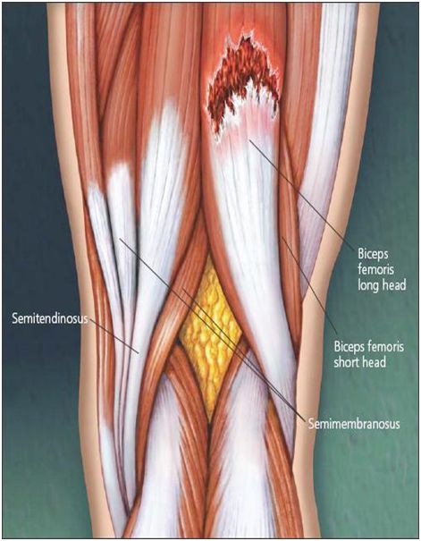 Dance Injuries, Intercostal Muscle Strain, Pulled Hamstring, Nerve Exercises, Fascia Stretching, Torn Hamstring, Passive Stretching, Muscle Tear, Hamstring Injury