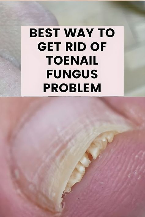 fungal nail remedies Fungal Infection Remedies, Homemade Nail Polish, Toenail Health, Nail Remedies, Toenail Fungus Remedies, Nail Infection, Fungal Nail, Ingrown Toe Nail, Toenail Fungus