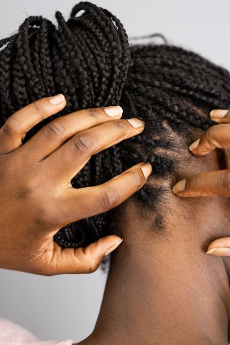 What Salicylic Acid Can Do For Your Scalp Dry Scaly Scalp, Scaly Scalp, Free Keto Meal Plan, Types Of Hair Extensions, Chocolate Lava, Lava Cake, Afro Textured Hair, Black Hair Care, Flaky Skin