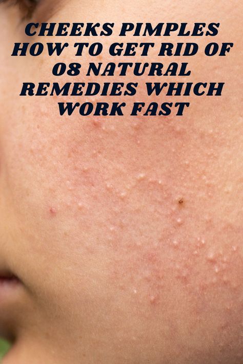 Cheeks Pimples How To Get Rid Of 08 Natural Remedies Which Work Fast #acne #pimples #pimplesremedies #acneremedies #skincarediy. https://whispers-in-the-wind.com/combatting-pimples-under-the-skin-expert-tips-and-product-recommendations/?46 How To Get Rid Of Papules, Small Pimples On Face Remedies, How To Get Rid Of Bumps On Cheeks, How To Get Rid Of Small Pimples On Face, Small Pimples On Face, Cheek Pimples, Pimple Remedies, Herb Remedies, Cheek Acne