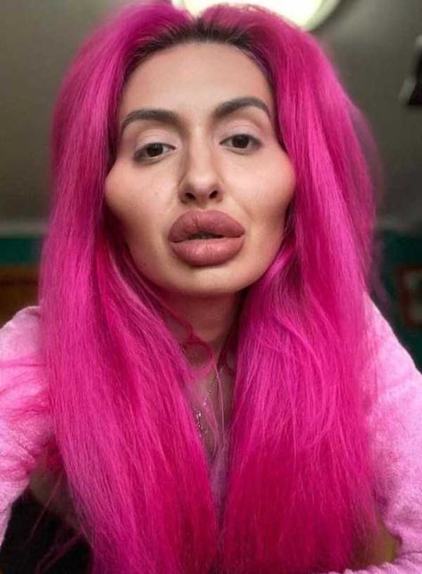 Burger Images, Plastic Surgery Fail, Bad Plastic Surgeries, Plastic Surgery Gone Wrong, Botox Lips, Celebrity Plastic Surgery, Under The Knife, Tummy Tucks, Dermal Fillers