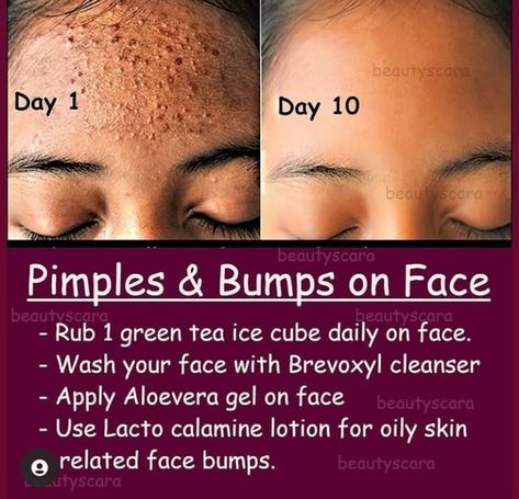 Small Pimples On Face, Bumps On Face, Small Bumps On Face, Face Skin Care Products, Mom Self Care, Beginner Skin Care Routine, Get Rid Of Pimples, Rid Of Pimples, Forehead Acne