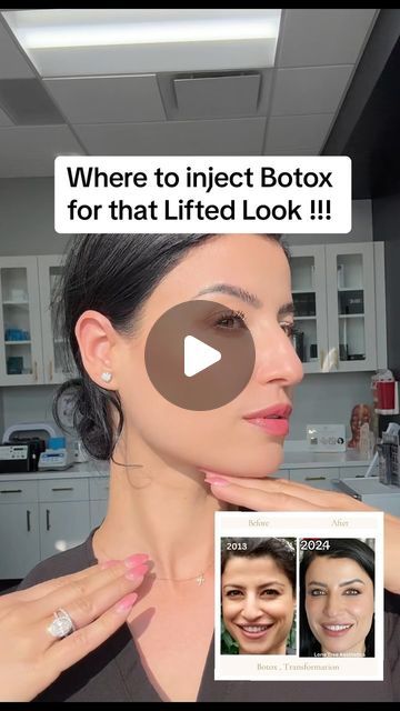 Enki Nichols | Lone Tree Aesthetics Med Spa on Instagram: "The number of Botox units needed varies from person to person and depends on several factors, including: Facial structure, Facial muscle strength and size, Desired outcome, Severity of wrinkles, Age, Gender, Skin condition, Previous Botox experience, Metabolism A qualified injector can help you determine the appropriate dosage and achieve the look you want. #botox #hoodedeyes #openeyes #browlift #eyelift #lipflip #dao #jowls #noselift #nosetox #nurseinjector #beforeandafter #educational #denvercolorado #lonetreecolorado" Botox Face Lift Before And After, Botox Eye Lift Before And After, Places To Get Botox On Face, Botox On Jawline, Preventative Botox Before And After, Botox Nose Job, Botox Locations On Face, Facial Botox Areas, Botox Units Needed