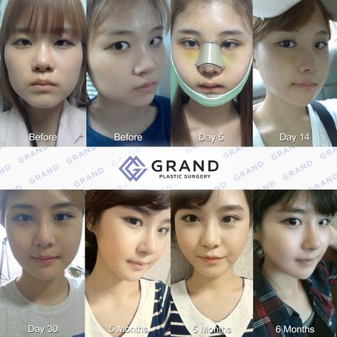 Grand is here to present you a new life with much better face after plastic surgery. *She had eye surgery, rhinoplasty and facial contouring at Grand. 😊 For free consultation Tel: (+82) 70-7119-1580 Mobile: (+82) 10-7156-6546(Whatsapp, Line, Kakaotalk, Viber, iMessage) Email: grandps.en@gmail.com Facebook: facebook.com/grandplasticsurgery Webstie: eng.grandsurgery.com Pinterest : https://www.pinterest.co.kr/grandps_eng/ Tumblr: http://grandsurgery.tumblr.com/ nstagram: grandps_eng Facial Fem Surgery, Facial Contouring Surgery, Plastic Surgery Korea, Dream Face, Plastic Girl, Facial Contouring, Nose Surgery, Eye Surgery, Cosmetic Surgery