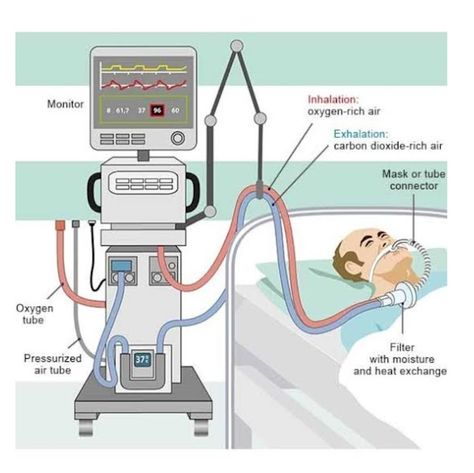 Educatrix: VENTILATOR in Critical Care Hospital Tools, Ventilator Settings, Arterial Blood Gas, Mechanical Ventilation, Types Of Surgery, Study Essentials, Respiratory Therapy, Chronic Obstructive Pulmonary Disease, Pulmonary Disease