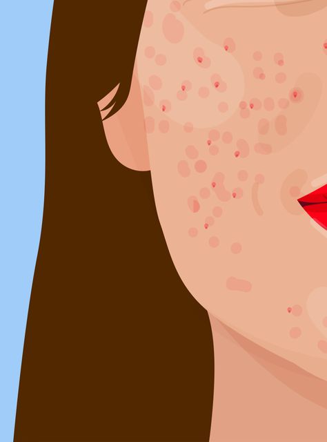 Body Positivity Art, How To Get Rid Of Pimples, Illustration Art Girl, 수채화 그림, Beauty Illustration, Feminist Art, Art And Illustration, Body Positivity, Coming Out