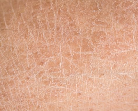 Dealing with Diabetic Skin Care Problems Scale Skin, Scaly Skin, Adrenal Fatigue, Skin Disorders, Flaky Skin, Rough Skin, Itchy Skin, Dehydrated Skin, Skin Problems