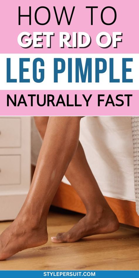 How to Get Rid of Leg Pimples Leg Pimples, Leg Acne, Calamine Lotion, Strawberry Legs, Heat Rash, Acne Vulgaris, Diy Body Scrub, How To Get Rid Of Pimples, Sweat Gland