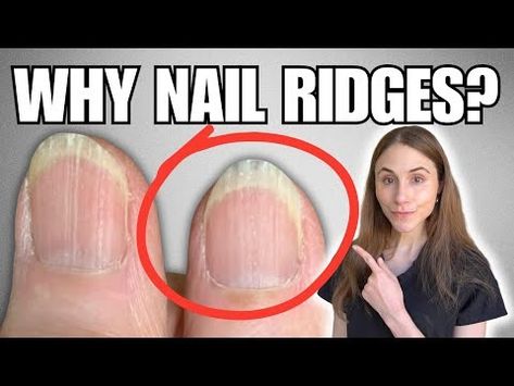 Why You Have Vertical Nail Ridges And How To Get Rid Of Them - YouTube Vertical Ridges On Fingernails, White Lines On Nails, Vertical Nail Ridges, Chia Puddings, Dr Dray, Nail Ridges, Split Nails, Nail Repair, Health Heal