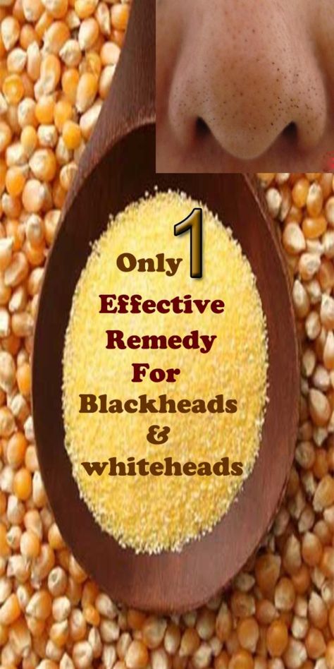 I am going to tell you how you can get rid of your blackheads and whiteheads permanently. Use this one ingredient to get rid of blackheads. Trust me, this remedy actually works to remove blackheads and whiteheads.Try it Whiteheads Removal Remedies Home, Whiteheads Removal Remedies, How To Get Rid Of Blackheads, How To Remove Whiteheads, Remove Whiteheads, Whiteheads Removal, Facial Remedies, Blackhead Remedies, To Remove Blackheads