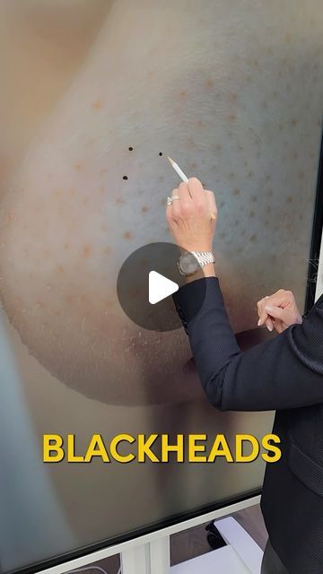 Dr. Janine Bowring, ND on Instagram: "How to Remove Tiny Black Spots on Skin 

Dr. Janine shares how to remove tiny black spots on skin.  She explains that these black spots look like mini poppy seeds and are usually on the nose and T-zone.  They are sebaceous filaments, not blackheads.  Dr. Janine recommends massaging jojoba oil into the area, leaving this on for 10 minutes, and then washing it off with warm water and a face cloth.  Follow for more natural health tips. 

#beauty #blackheads #skincare #holistic #holistichealth #drjanine" Face Black Spot Removal, Black Dots On Face, Black Head Removal Video Nose, Red Skin Spots, Black Spots On Face, Forehead Bumps, Spots On Skin, Sagging Cheeks, Sebaceous Filaments