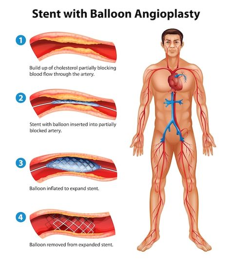 Improve Leg Circulation, Leg Circulation, Interventional Radiology, Vascular Surgery, Poor Circulation, Medication Management, Medical Coding, Cardiovascular System, Medical Knowledge