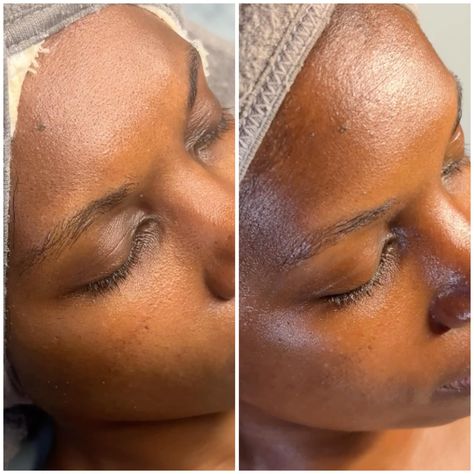 Consistency brings results! 🌟 Check out these incredible results after just two treatments at Skynvy Houston. Notice the visible improvements in skin texture and radiance between the first and second sessions. Consistent professional care combined with diligent home skincare routines truly makes all the difference. Swipe to see the transformation and imagine what could be achieved with continued care! Are you ready to begin your own skin transformation journey? Book your appointment today an... Skin Transformation, Chemical Peels, Chemical Peel, Skincare Routines, Book Your Appointment, Best Skin, Skin Texture, Care Routine, Skin Care Routine