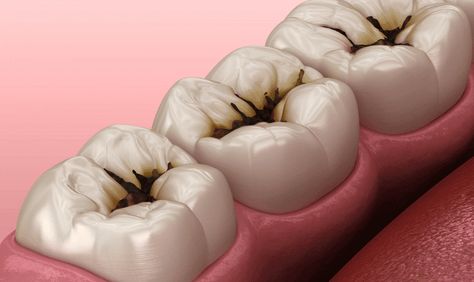 A tooth cavity, or dental caries or decay, is a localized area of damage to the tooth’s hard tissues, primarily caused by bacterial activity. When sugars and starches in food interact with bacteria in the mouth, they produce acid that erodes the tooth enamel. Over time, this process leads to the formation of cavities, compromising the tooth’s structure. Dental Pictures, Dental Advertising, Dental Images, Tooth Cavity, Dental Decay, Dental Videos, Dental Technician, Tooth Enamel, Dental Floss