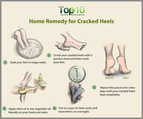 Remedy For Cracked Heels, Fix Cracked Heels, Remedies For Cracked Heels, Heal Cracked Heels, Cracked Heel Remedies, Dry Cracked Heels, Dry Heels, Top 10 Home Remedies, Sugar Scrub Diy