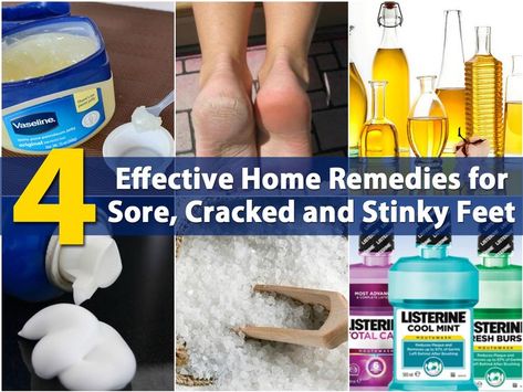 4 Effective Home Remedies for Sore, Cracked and Stinky Feet - DIY & Crafts Cracked Heel Remedies, Listerine Cool Mint, Skin Bumps, Keratosis Pilaris, Cracked Heels, Beauty Remedies, Natural Therapy, Skin Remedies, Health And Beauty Tips