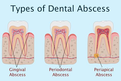 Absessed Tooth, Abcessed Tooth, Dental Abscess, Abscess Tooth, Teeth Remedies, Dental Social Media, Tooth Infection, Dental Health Care, Tooth Removal