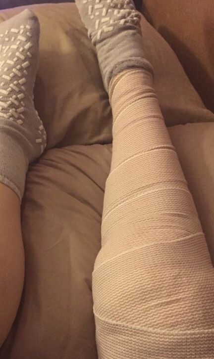 Leg Bandage Snapchat, Broke Leg Snapchat, Broke Leg, Bandage On Hand Dpz, Fake Photo Sick, Addison Cinema, Hospital Photography, Lip Care Routine, Minimalist Quotes