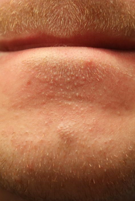 Cleft Chin Aesthetic, Why Do I Have Acne On My Chin, Bumps On Chin Not Acne, What Does Acne On Your Chin Mean, Chin Acne Causes, Abdominal Stretches, Skin Bumps, Chest Congestion, Lower Lip