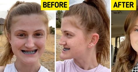 In a world where people are all about finding themselves and facing challenges, a young woman bravely shares her experience of getting double jaw surgery. She takes everyone along on her journey, showing the ups and downs of the process. As she reveals the before-and-after pictures, people can’t help but be amazed at the incredible results. Double Jaw Surgery Before And After, Jaw Surgery Before And After, Double Jaw Surgery, Chin Implant, Plastic Surgery Gone Wrong, Jaw Surgery, Pictures People, Liquid Diet, Facing Challenges