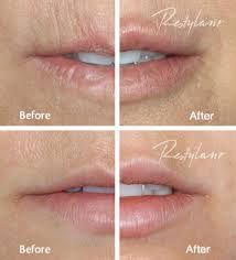 Lips Injection, Restylane Lips, Juvederm Lips, Botox Lips, Aesthetic Dermatology, Lip Art Makeup, Plastic Fantastic, Facial Fillers, Best Lip Gloss