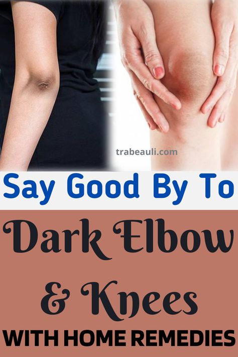 Some amazing home remedies for black elbow and knees to get rid of dark elbows overnight. These remedies daily or even alternate days use and you will find a great change in your knee and elbow skin. Check out the blog- #darkknees #darkelbows #homeremedies #elbowandknees #removeblackelbow How To Lighten Knees, Sagging Cheeks, Dark Elbows, Dry Elbows, Spots On Legs, Dark Underarms, Dark Spots On Skin, Remove Dark Spots, Saggy Skin