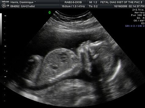 Hold or frame a picture of baby's ultra sound during birth to remind you despite the pain the greatest blessing and gift in the end will be your precious baby. <3 Ultra Sound Pictures, Ultra Sound, Sound Free, Sound Picture, Book Pins, Baby Pics, Paper Rolls, Medical Field, 2024 Vision