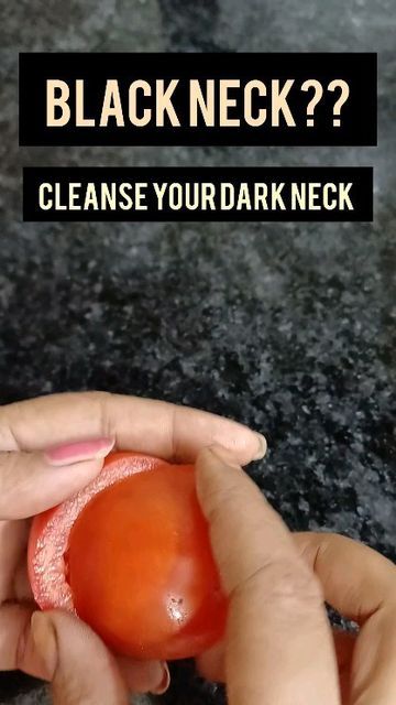 How To Remove Sunburn, Dark Spots On Neck, Dark Neck Remedies, Pigmentation Remedy, Sunburn Peeling, Dark Neck, Energy Boosting Foods, Healthy Heart Tips, Natural Face Care