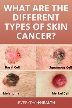 Basal Cell, Skin Moles, Squamous Cell, Types Of Skin, How To Remove Pimples, Breast Health, Everyday Health, Health Planner, Skin Disorders