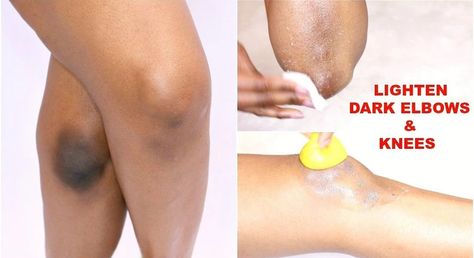 How To Lighten Knees, Lighten Dark Elbows, Dark Elbows And Knees, Dark Spots Under Armpits, Dark Spots On Legs, Dark Knuckles, Dark Elbows, Lighten Skin Tone, Spots On Legs