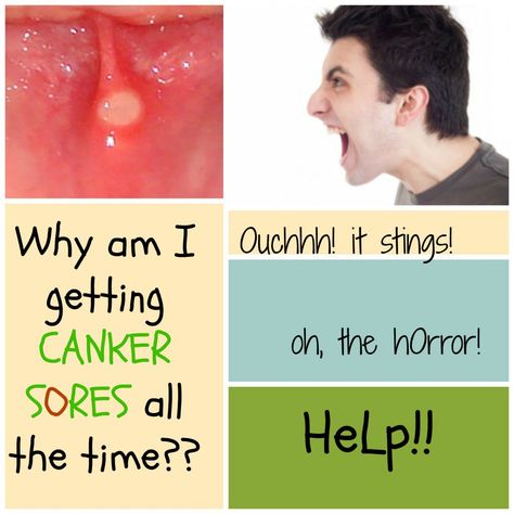 Canker sores are painful and annoying. By knowing the possible causes of canker sores, we can learn to prevent canker sores from appearing again. Highly acid foods can burn the soft skin in our mouth Mouth Blister Remedy, Blister In Mouth, Canker Sore Causes, Mouth Blisters, Canker Sore Remedy, Natural Remedies For Migraines, Canker Sore, Dry Skin Remedies, Cold Sores Remedies