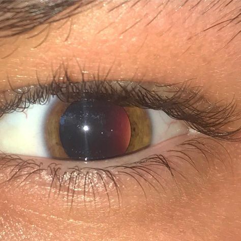 Inside dilated eye looks like neutron star nearing a bigger star Stars In Eyes, Big Pupils, Star Pupils, Dilated Eyes, Pupils Dilate, Dilated Pupils, Neutron Star, Photos Of Eyes, Eye Looks