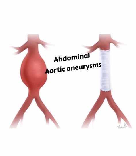 Aortic aneurysms . What my patients need to know about abdominal aortic aneurysms (AAA)p Aortic Arch, Abdominal Aorta, Brain Surgeon, Blood Pressure Control, Natural Face Cleanser, Abdominal Surgery, Working Mom Tips, When You Sleep, Abdominal Pain