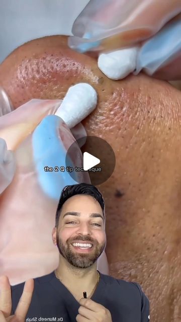 Sebaceous Filaments Removal, Splinter Removal Video, Closed Comedones Skin Care, Oddly Satisfying Videos Blackheads, Spot Popping Videos, Big Blackheads Removal Satisfying Videos, Huge Blackheads Extraction Videos, Ear Pimple Poppìng Videos, Black Heads Popping