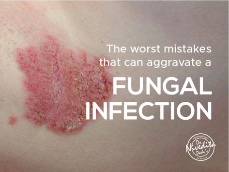 Fungal infection is an infectious skin condition  leading to irritation, scaly skin, redness, itching, swelling, and blisters. It can take place anywhere on the body. Once fungal infection is acquired, it takes quite some time to get rid of it.    Read the blog and find out the worst mistakes that can aggravate a fungal infection Staphylococci Bacteria Infection On Skin, Skin Rash Remedies, Fungal Rash, Fungal Infection Remedies, Skin Fungus, Rashes Remedies, Fungal Infection Skin, Sick Remedies, Scaly Skin