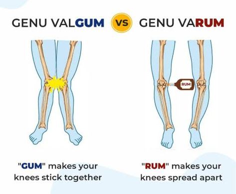 Genu Valgum, Genu Varum, Medicine, Make It Yourself