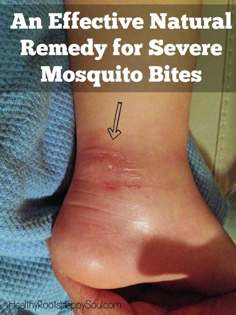 Mosquito Bites, Natural Healing Remedies, Mosquito Bite, Holistic Remedies, Natural Therapy, Homemade Remedies, Natural Remedy, Natural Health Remedies, Natural Home Remedies